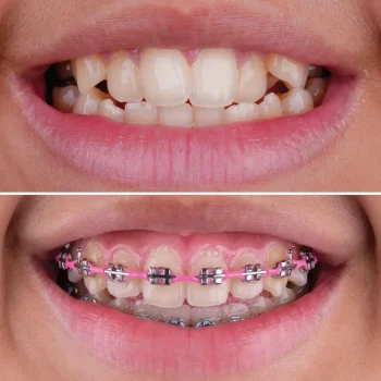 orthodontic treatment