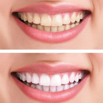 whitening